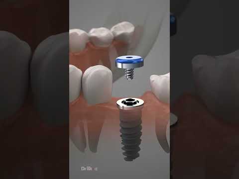 Dental Implant Procedure